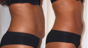 Inch-Loss-Before-and-After-laser-treatment-for-stomach